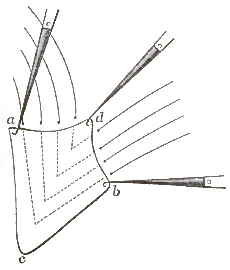 Operation for perineorrhaphy